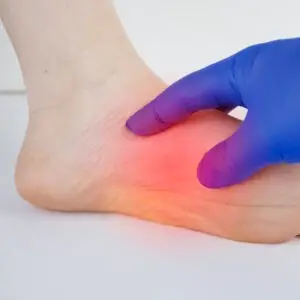 Diagram showing inflammation from plantar fasciitis in the heel